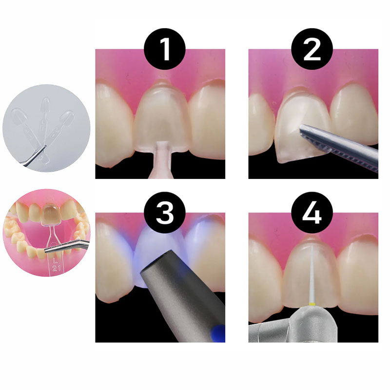 Kit de moldes dentales de resi - Teeth Whitening Moulds reseña y precio