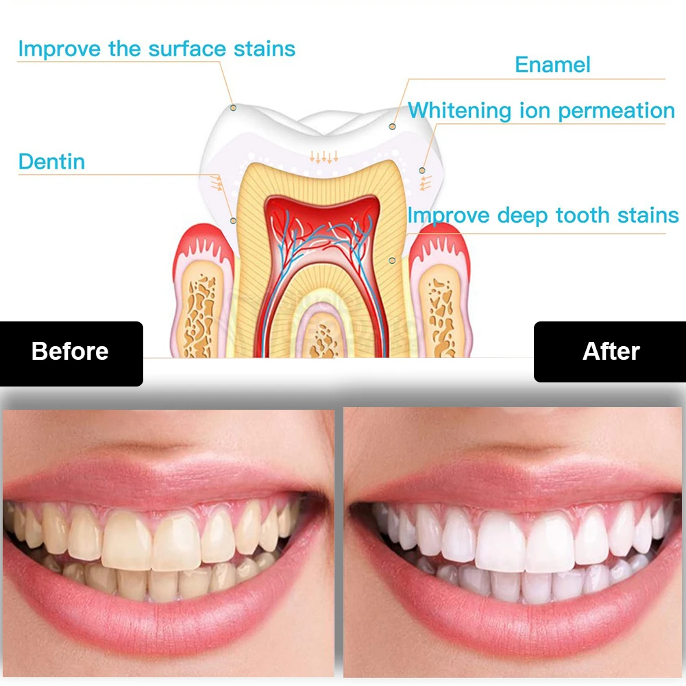 Kit de blanqueamiento Dental M - Teeth Whitening Laser reseña y precio