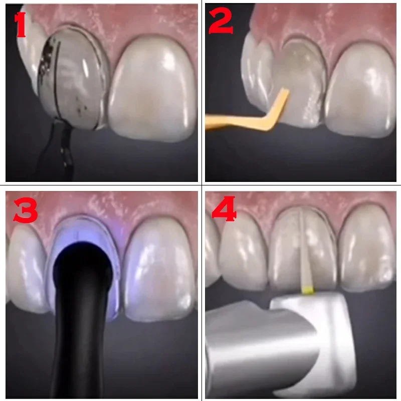 Molde dental para carillas de  - Teeth Whitening Moulds reseña y precio