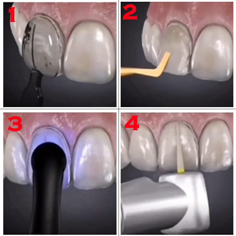 Kit de 32 Moldes Dentales para - Teeth Whitening Moulds reseña y precio