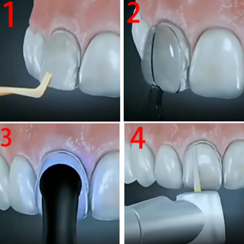 Kit de moldes de chapa Dental, - Teeth Whitening Moulds reseña y precio